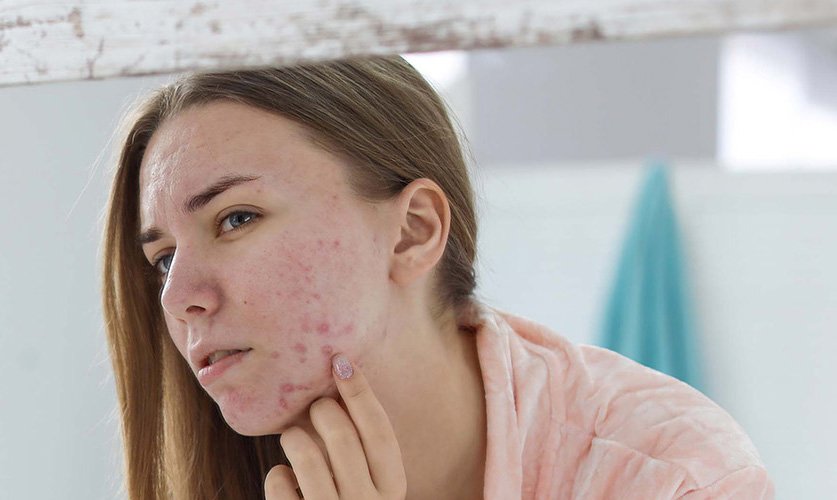 Laser Treatment for Acne Scars